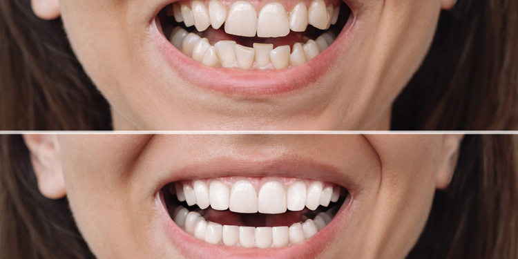 Close-up of a person's teethAI-generated content may be incorrect.